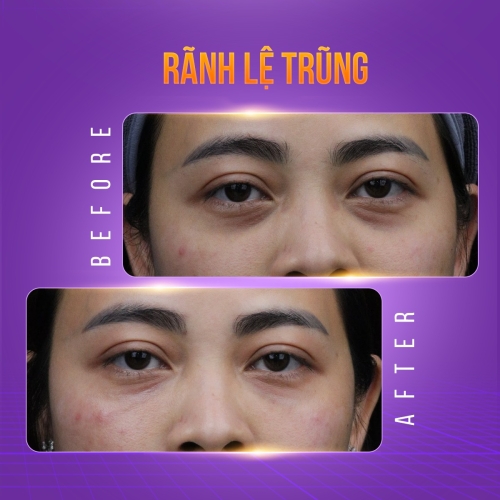 Tiêm HA mắt - Giải pháp trẻ hóa vùng mắt chỉ sau 15 phút