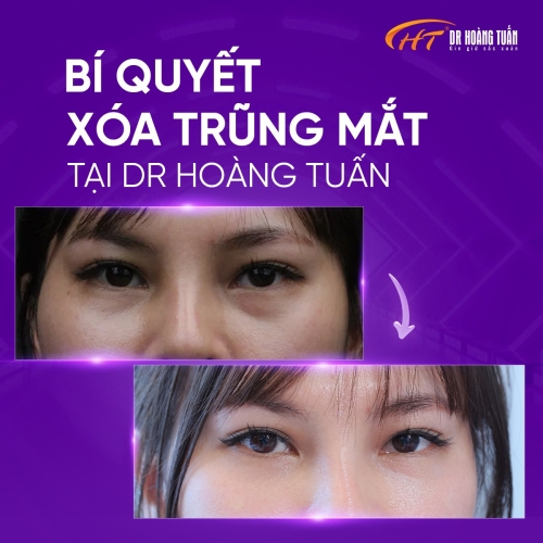 Tiêm HA làm đầy hốc mắt có hiệu quả không? Giải đáp từ chuyên gia