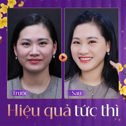 Tiêm Meso se khít lỗ chân lông có hiệu quả không?