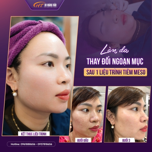 Có nên tiêm meso hay không? Những lưu ý quan trọng trước khi quyết định