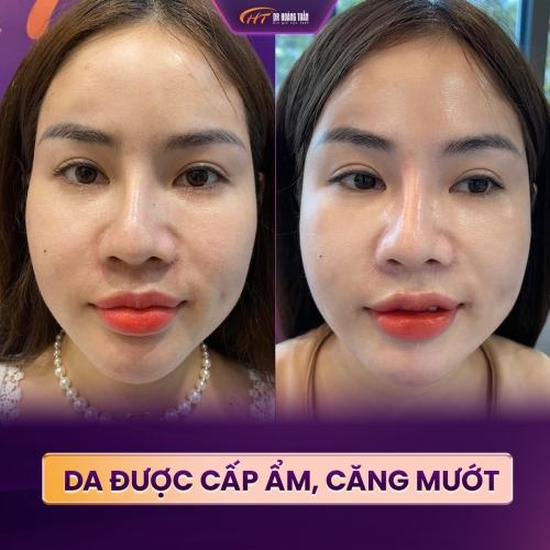 Tiêm meso có tác dụng gì? Địa điểm tiêm meso ở đâu an toàn?