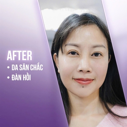Trẻ hóa da vùng cổ là gì? Phương pháp nào hiệu quả nhất?