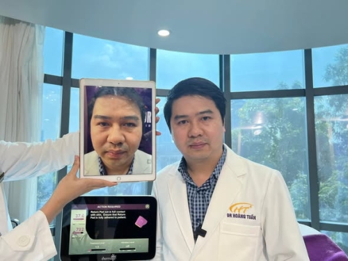 Nâng cơ trẻ hóa da Thermage FLX có đau không?