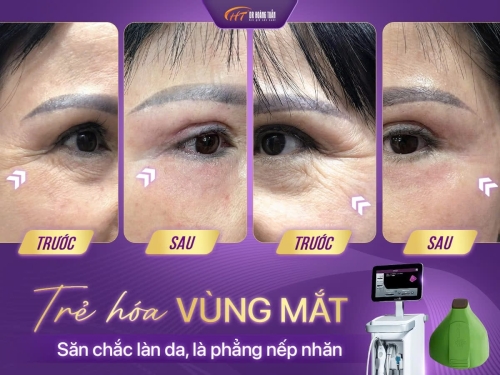 Thermage flx mắt - trẻ hóa vùng mặt toàn diện