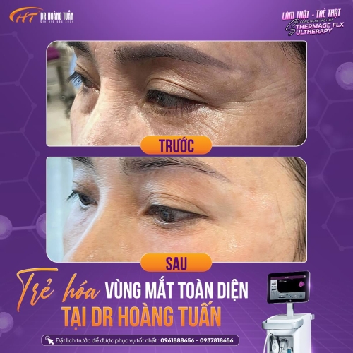 Trẻ hóa da vùng mắt không phẫu thuật – Lựa chọn làm đẹp được yêu thích