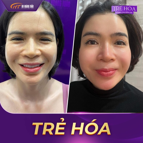 Thẩm mỹ không phẫu thuật