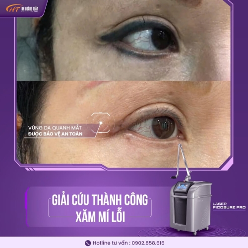 Xóa xăm mí mắt bằng cách nào an toàn và hiệu quả?