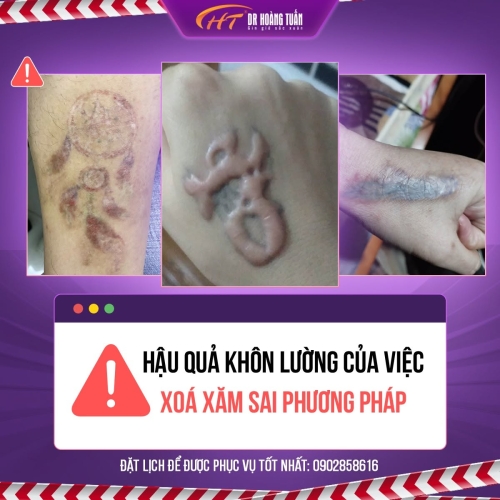Xóa xăm bị nhiễm trùng: Nguyên nhân, dấu hiệu và cách xử lý