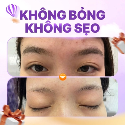 Xóa xăm chân mày bằng laser có hiệu quả như thế nào?