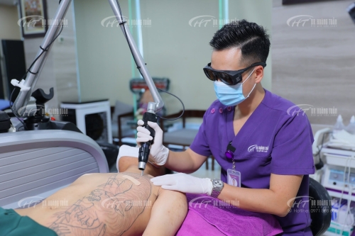 Xóa xăm bằng pico laser có hiệu quả không?