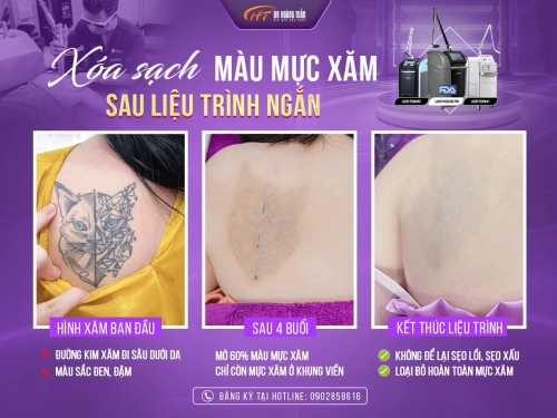 Xóa xăm bằng công nghệ laser picosure có hiệu quả không?