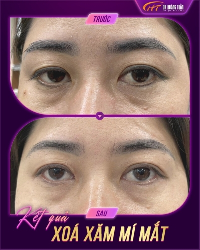 Xóa xăm lông mày có bị rụng lông không? Những điều cần biết