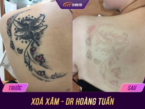 Xóa xăm laser có tốt không? Hiệu quả xóa xăm như thế nào